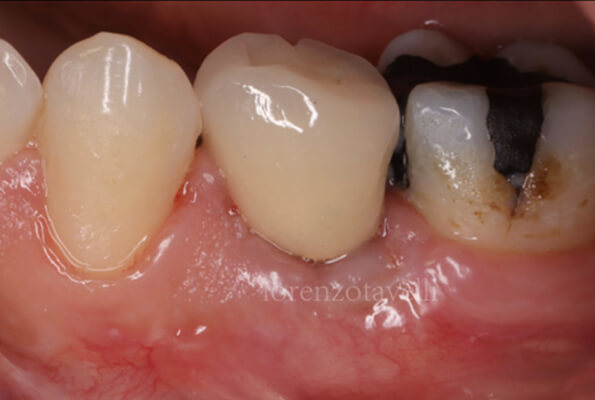Caso 5 - Dopo
