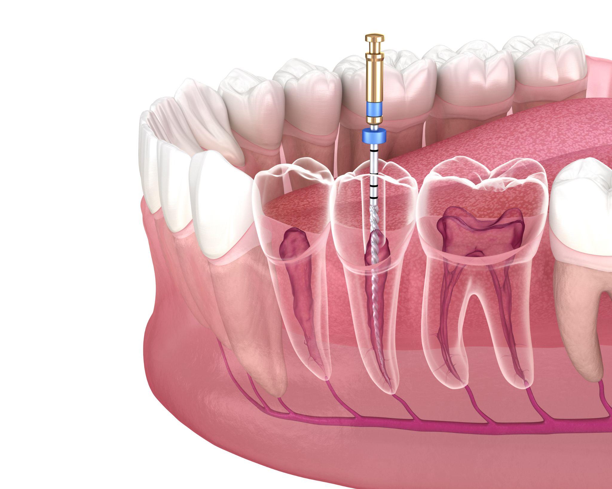 Conservativa ed endodonzia